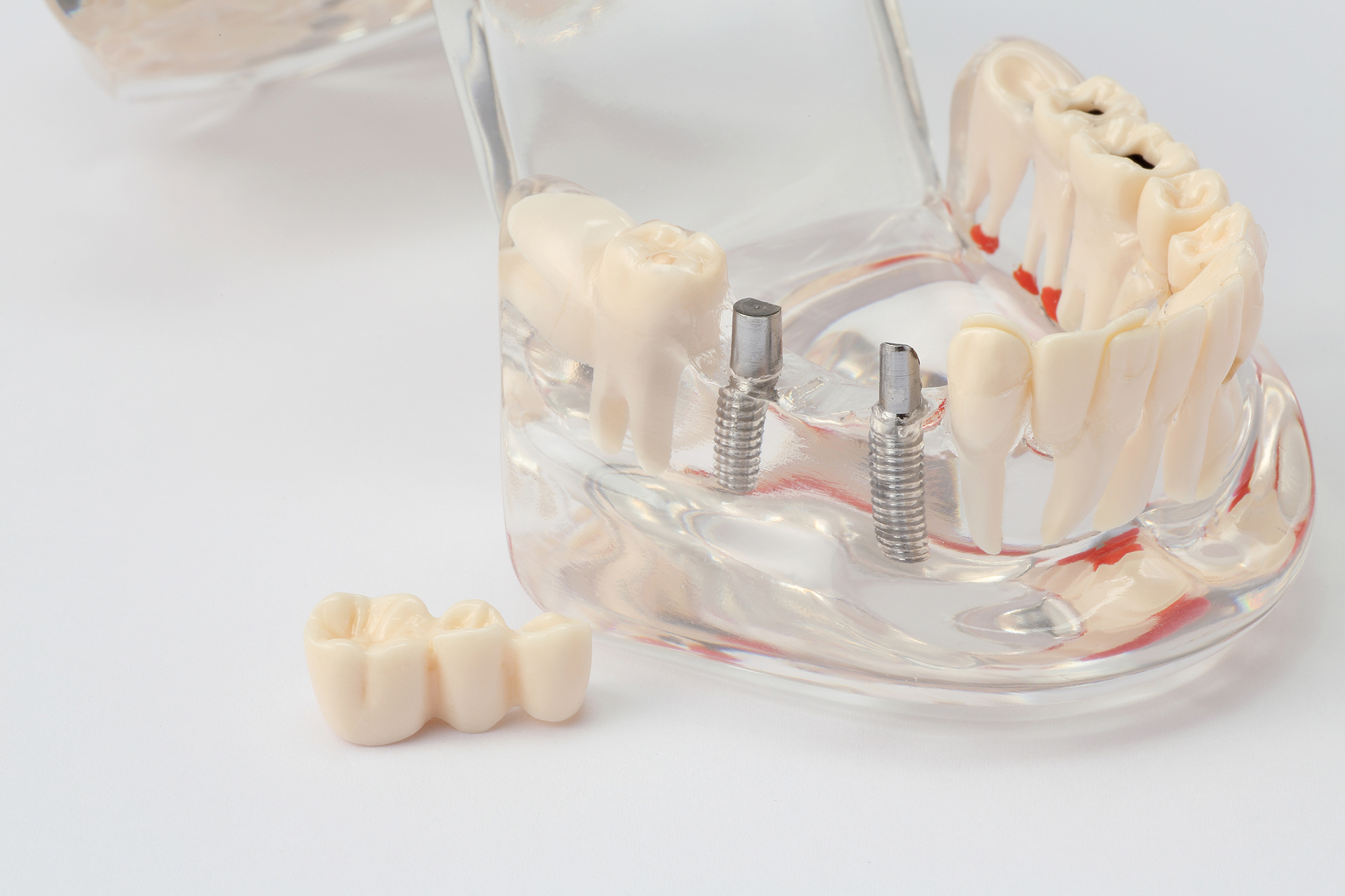 歯が失われたとき、「第二の永久歯」インプラントという選択肢があります